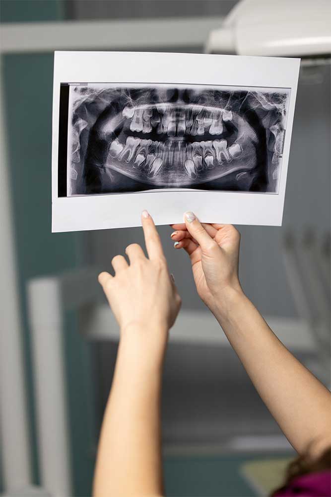 dentist holds up an xray showing wisdom teeth ready for removal