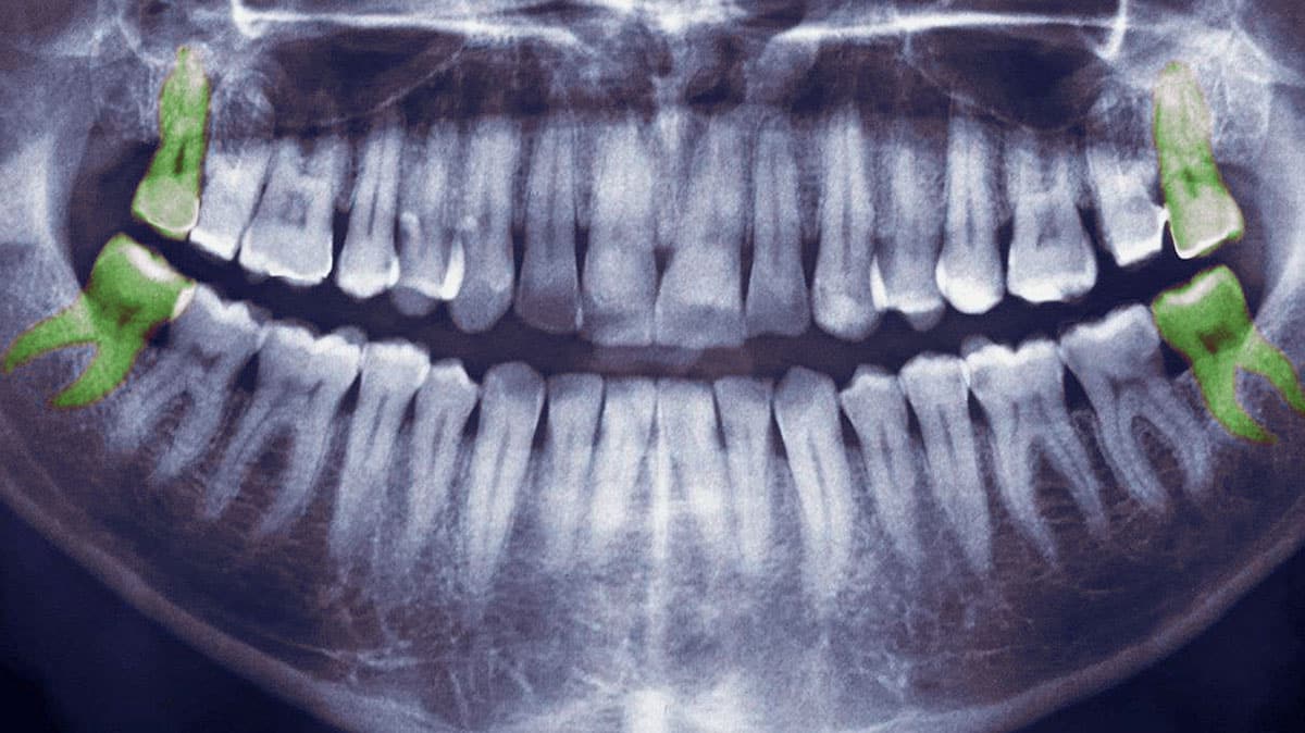 x-ray image highlighting the locations of wisdom teeth in the adult jaw