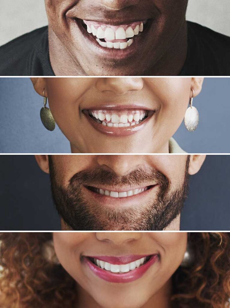 4 different peoples smiles stacked on top of each other to show how the dental emergency appointment process can help restore a healthy smile
