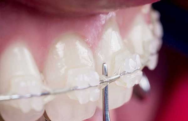 image showing ceramic braces