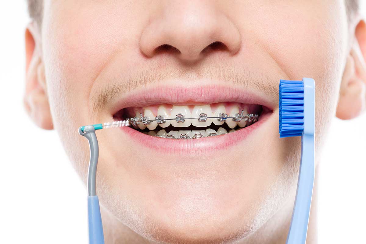 The ultimate guide to oral hygiene with braces - Martindale Dental