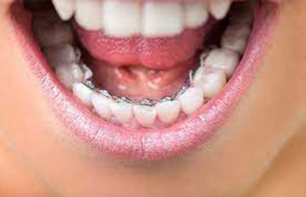 photo showing lingual braces on the bottom row of teeth