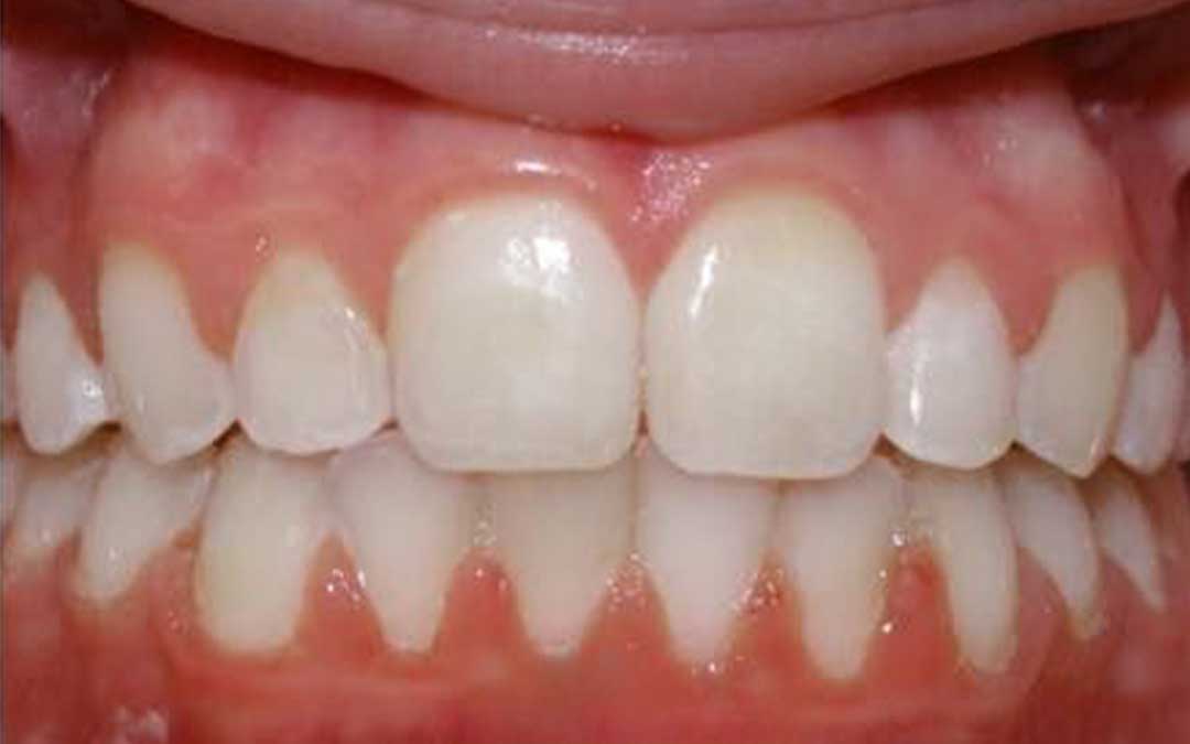 teeth after orthodontic treatments