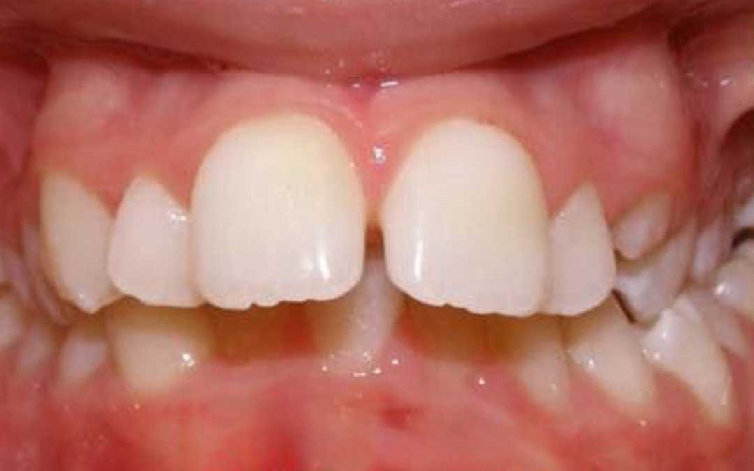 teeth before orthodontics image