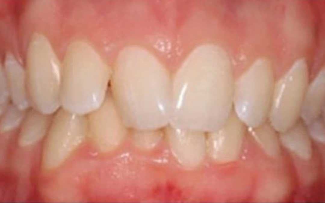 what teeth look like before braces
