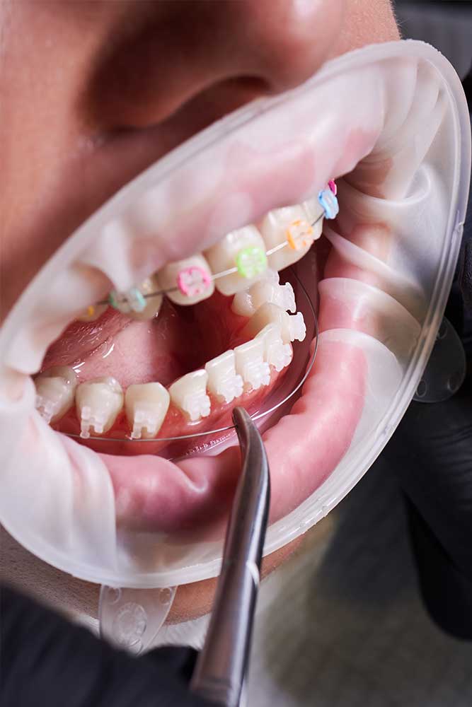 image of an open mouth showing orthodontic braces with colourful elastic bands