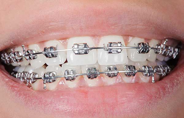 photo showing an up close shot of metal braces
