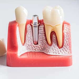a 3d model of dental implants