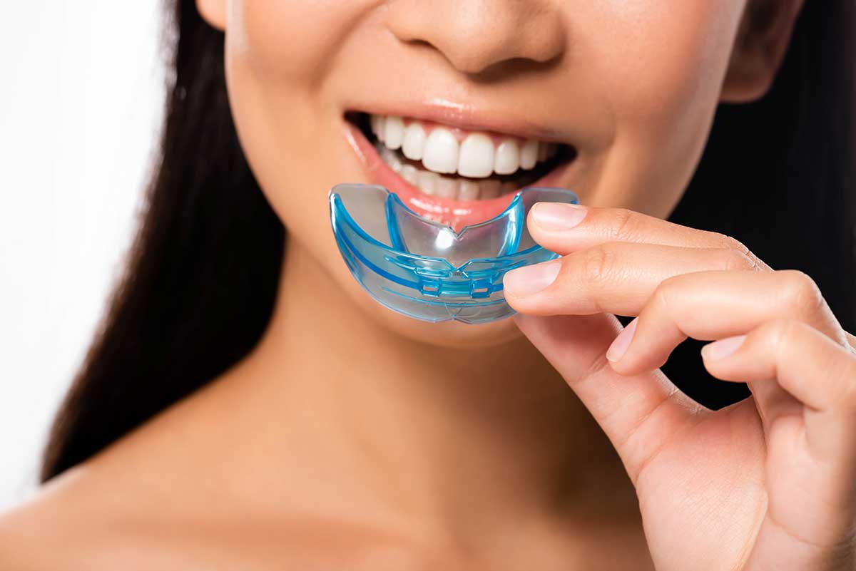 woman putting a blue mouthguard into her mouth