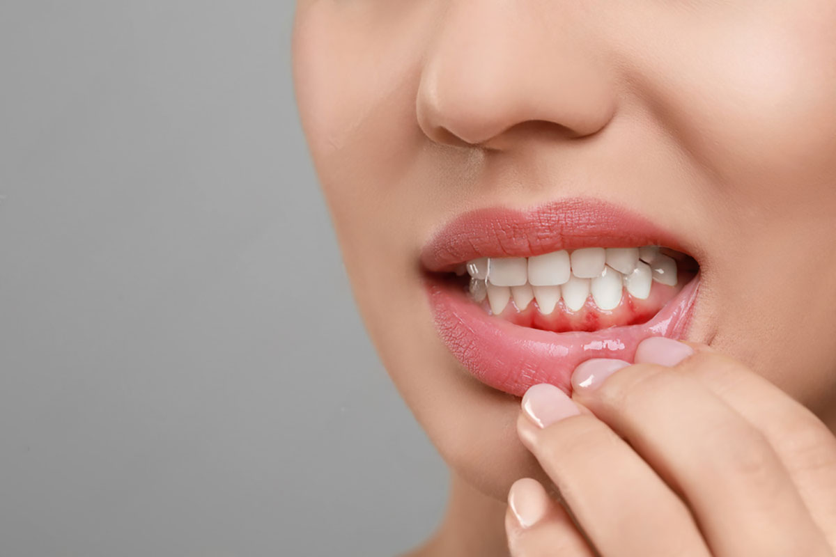 woman grimaces as she shows a red and swollen lower gum portion of her jaw/teeth