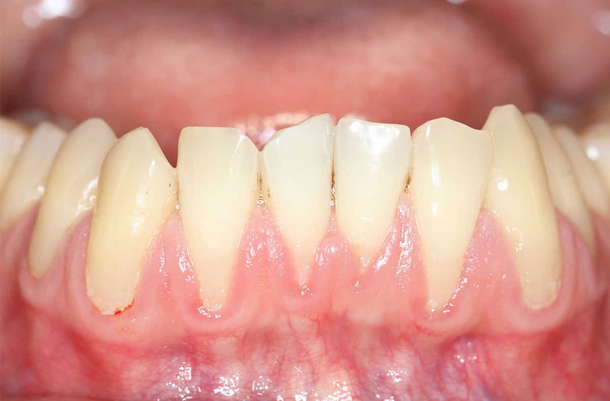 photo showing a close up of a persons mouth with a receding gumline