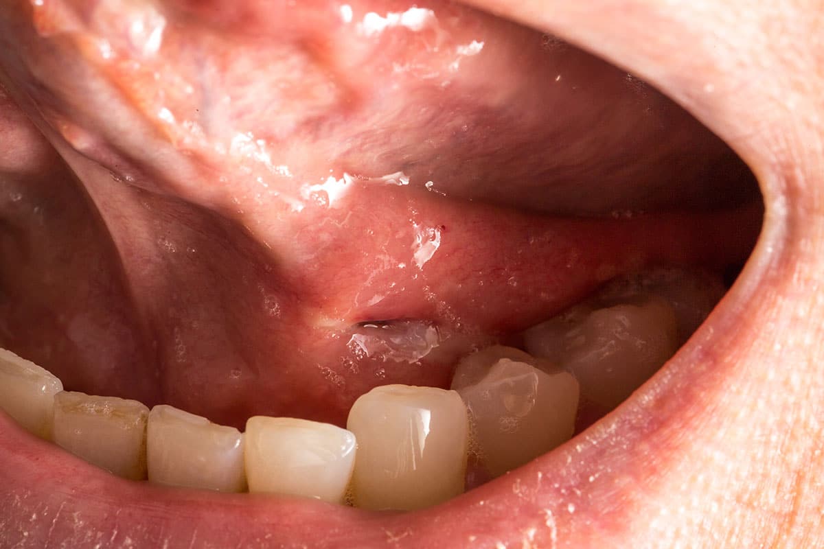 up close shot of a persons mouth with potential oral cancer showing