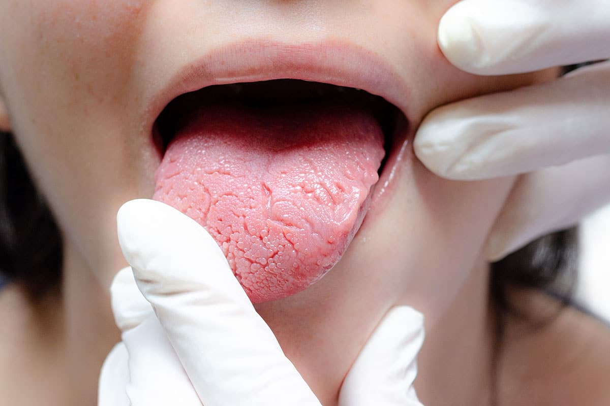 dentist is examining the tongue and mouth of a dry mouth sufferer