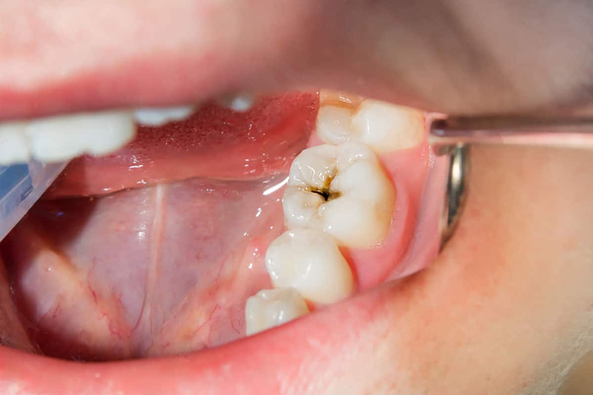 image showing a worsening cavity in the mouth of a diabetic