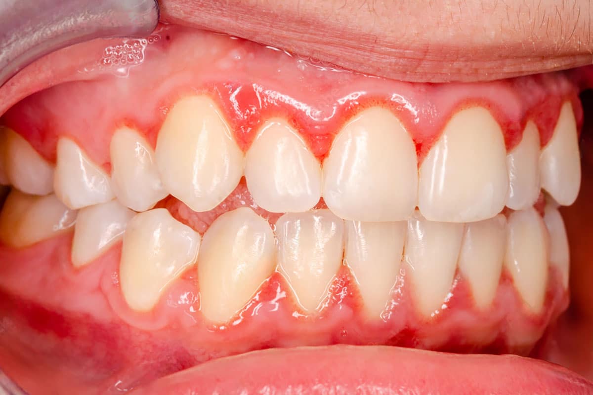 image showing what gingivitis looks like for a diabetic