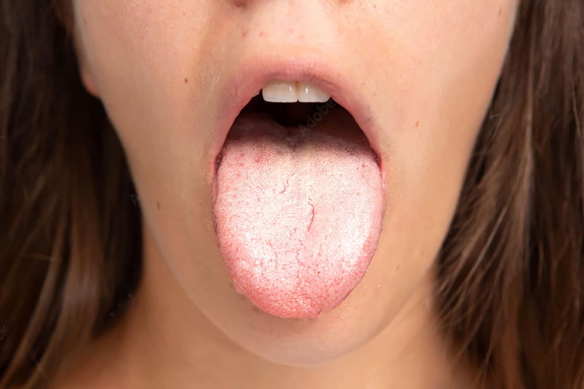 woman affected by diabetes shows her oral thrush covered tongue