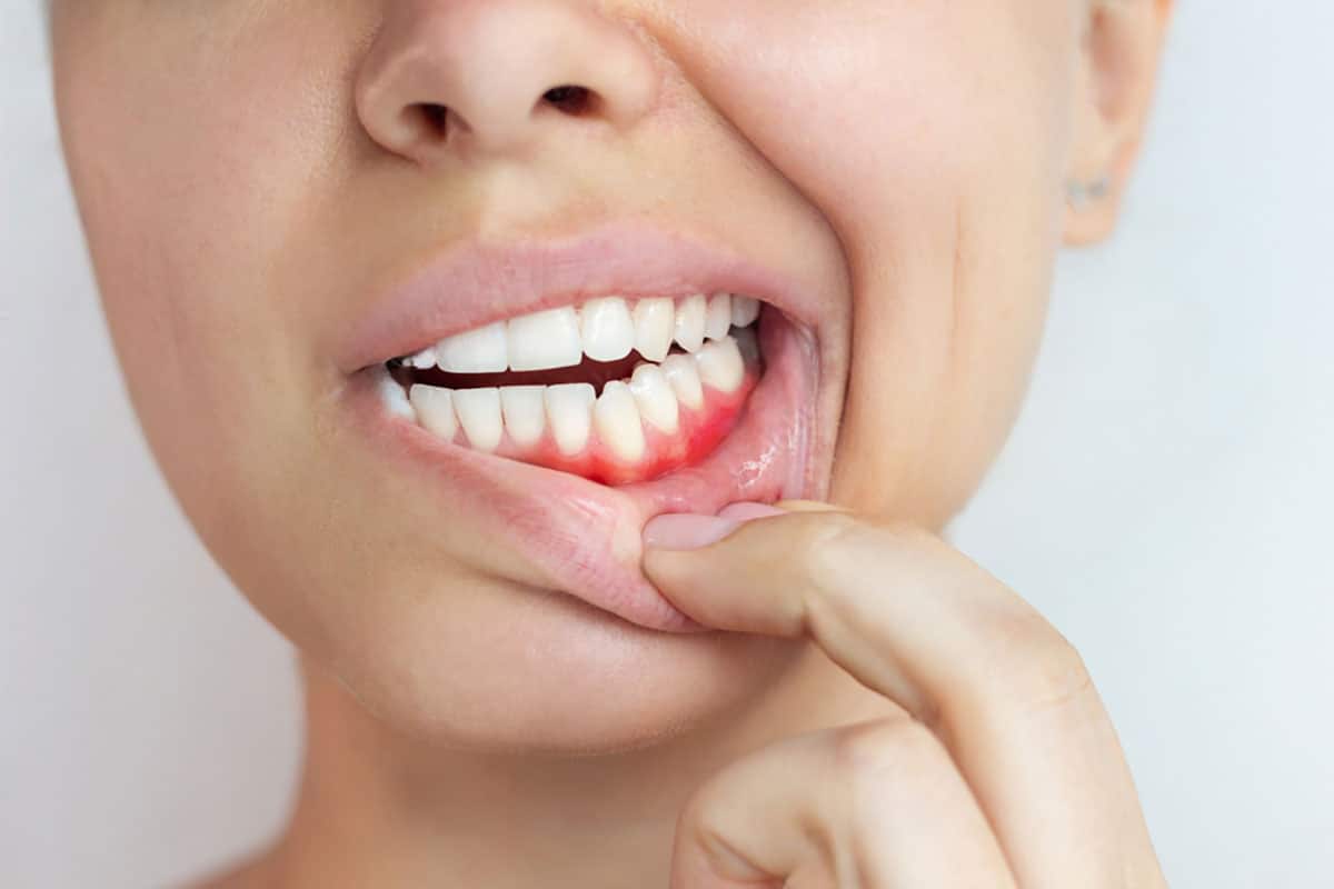 woman pulling down her lower lip to show her inflamed gums