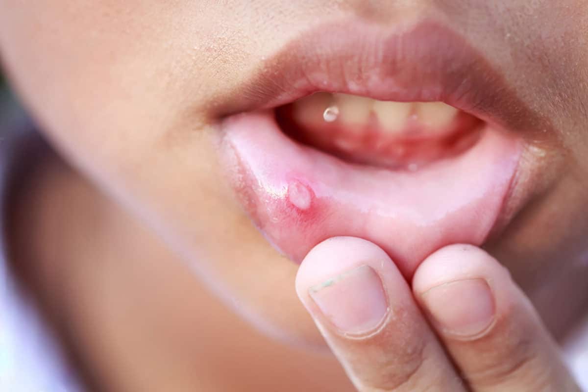 person showing a canker sore located on the inside of their lower lip