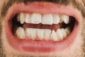 man showing a chipped tooth wondering what to do about it