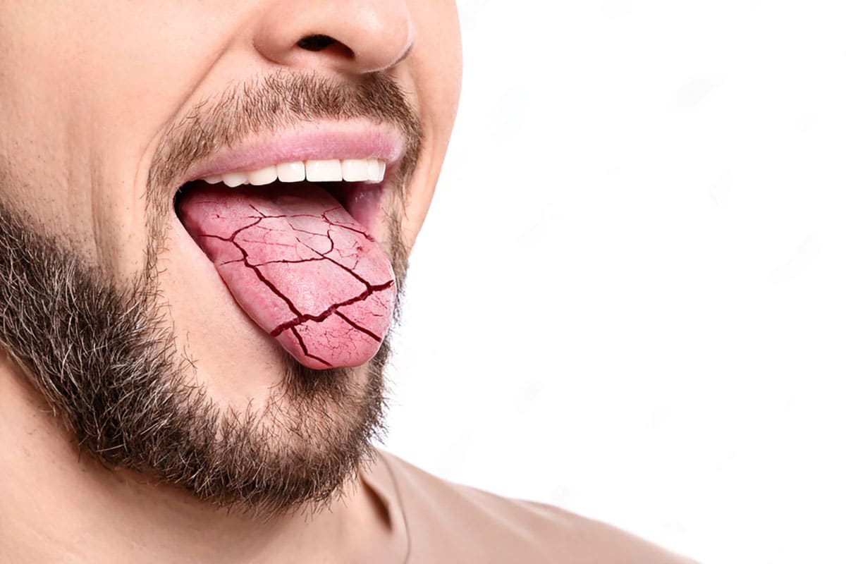 man sticks his dry and cracked tongue out to show xerostamia