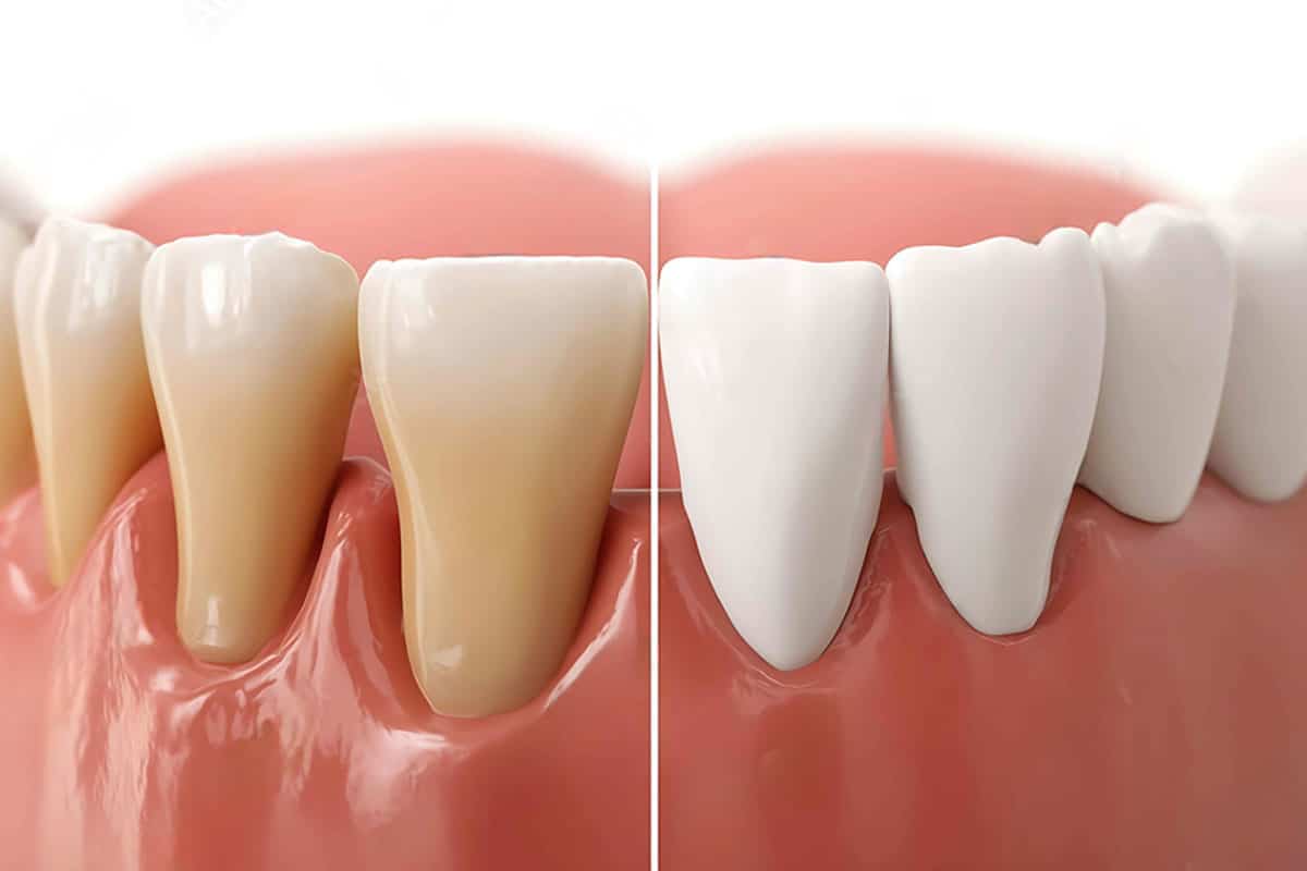 3d graphic showing what receding gums look like vs healthy gums