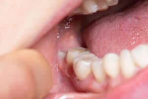 mouth full of saliva as the featured image of the role of saliva in oral health article