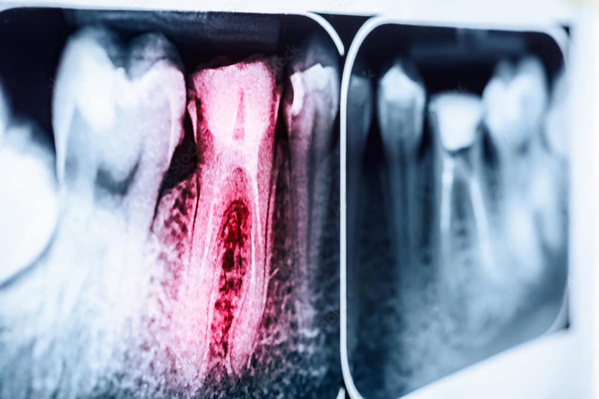 xray image with the abscessed tooth highlighted by a red glow