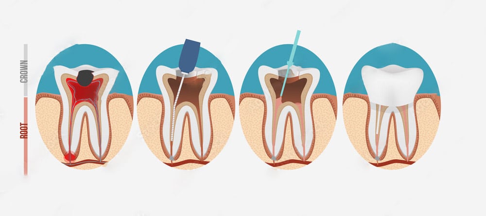 diagram showing what's involved in a root canal treatment procedure