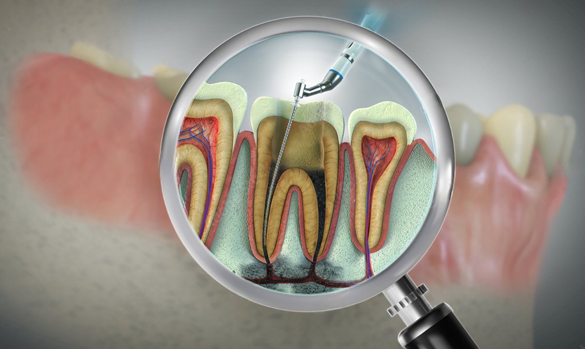 magnifying glass over a crfoss section of an abscessed tooth that is being repaired via a root canal treatment