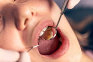 photo of a patients open mouth as our hamitlon dentist works on a cavity using the atraumatic restorative treatment (ART) option