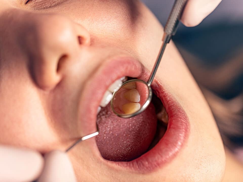 photo of a patients open mouth as our hamitlon dentist works on a cavity using the atraumatic restorative treatment (ART) option