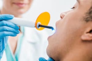 image of a man having dental sealants applied to his teeth. image is showing the UV light hardening process taking place.