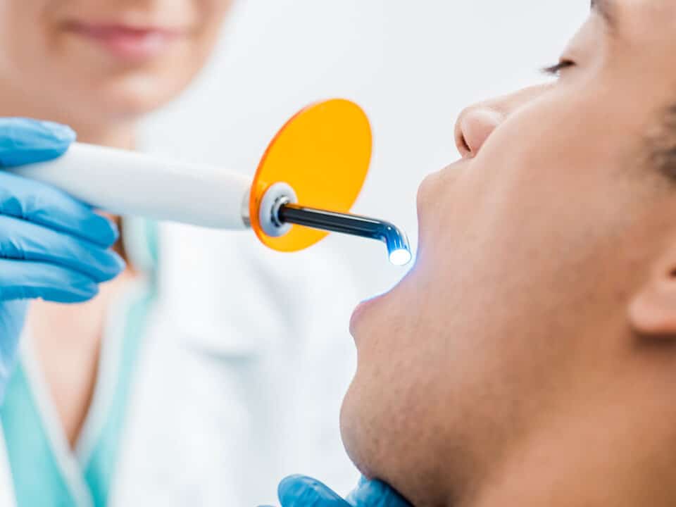 image of a man having dental sealants applied to his teeth. image is showing the UV light hardening process taking place.