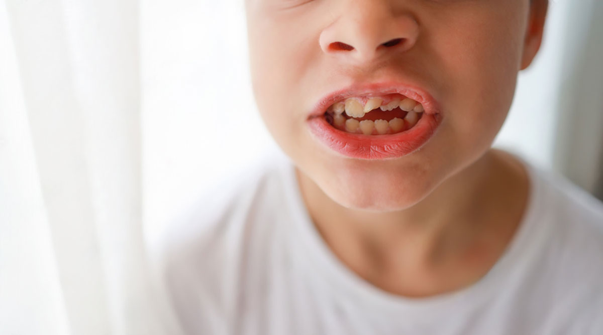 young boy shows his misaligned teeth which were caused by prolonged thumb sucking