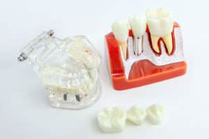 this is the featured image for our dental implants vs dental bridges article showing a set of bridges next to an implant model so patients can see the visual differences