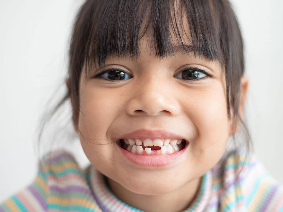 small girl showing the gap in her teeth after she lost on that should be filled with space retainers for kids