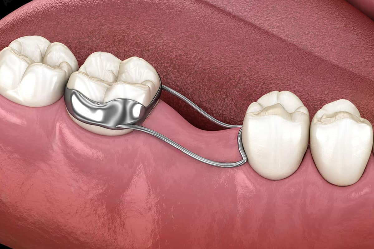 image of a typical space retainer for kids used by orthodontists and dentists to keep the shape of children's jaws if they lose teeth