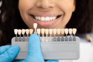 woman is having her teeth shade checked as she considers the question should you whiten teeth before restorations