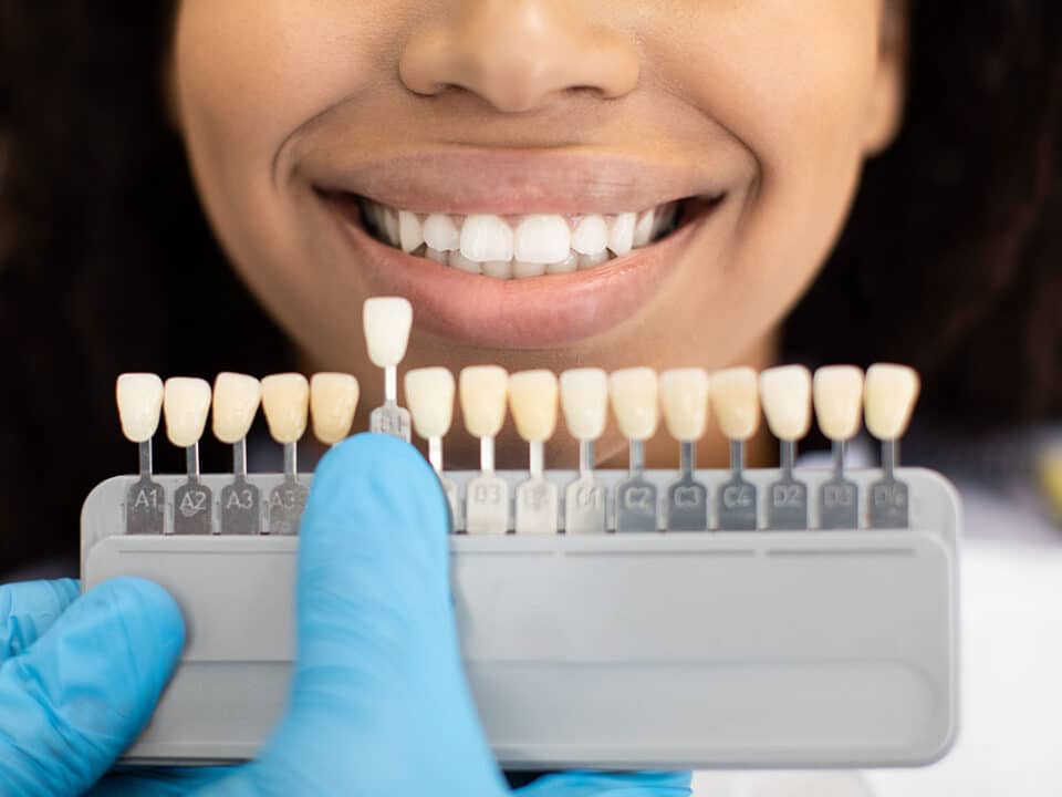 woman is having her teeth shade checked as she considers the question should you whiten teeth before restorations