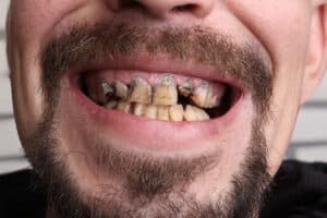 picture of a mans mouth that is totally rotted, showing a prime example of what happens if you skip dental cleanings