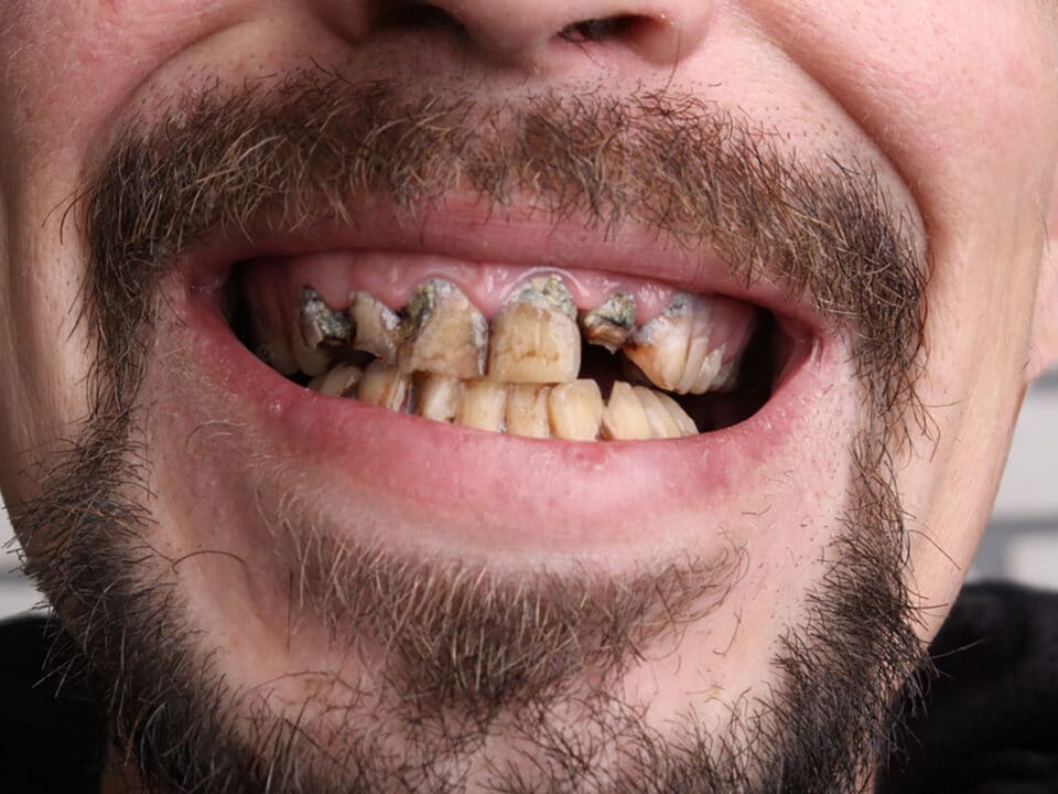 picture of a mans mouth that is totally rotted, showing a prime example of what happens if you skip dental cleanings