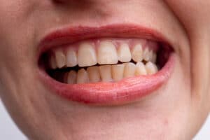 a woman shows off deeply stained teeth as she wonder about the best ways to remove deep stains from teeth