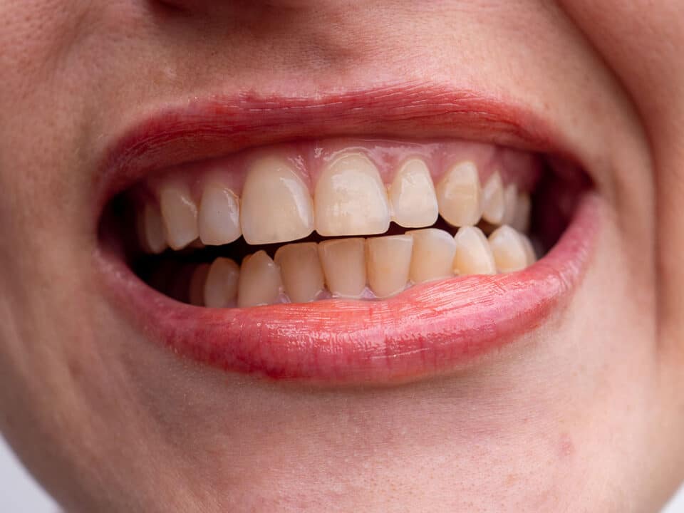a woman shows off deeply stained teeth as she wonder about the best ways to remove deep stains from teeth