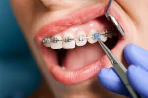 woman is having her braces adjusted by a dentist after she raised the question of can braces or aligners move teeth too fast