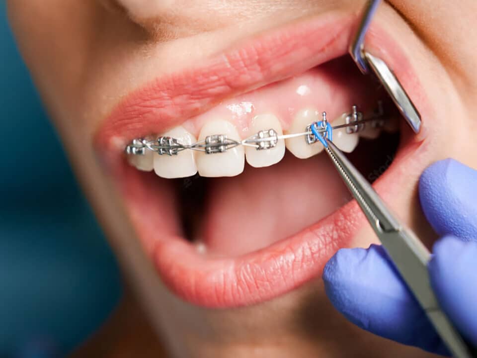 woman is having her braces adjusted by a dentist after she raised the question of can braces or aligners move teeth too fast