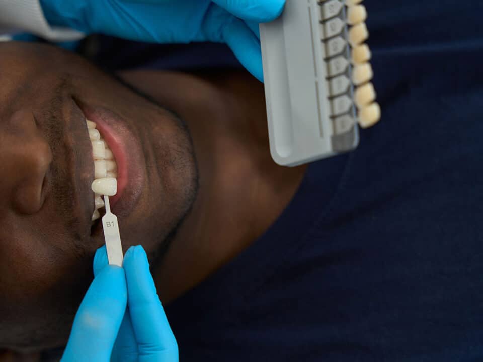 man at the dentist having veneers test fitted after discussing which option - dental crowns vs onlays vs veneers - would be best for his case
