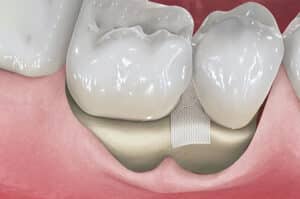 graphic 3d example of guided tissue regeneration for recessed gums