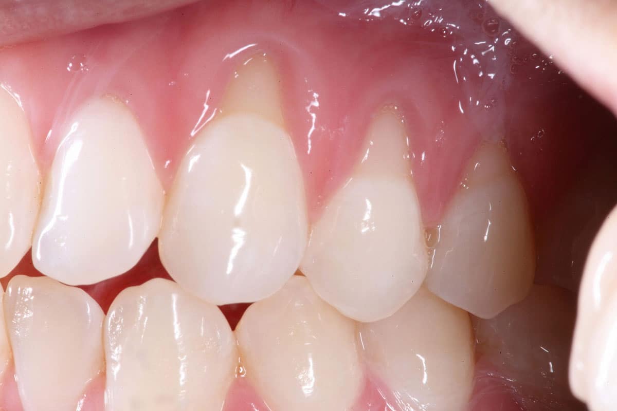 actual patient mouth photo of gum recession showing on the upper gums and teeth