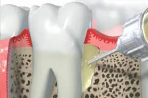 graphical example of protein enhanced gum tissue regeneration