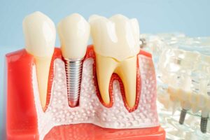 3d model of an implant in between two healthy teeth to show the signs and symptoms of peri-implantitis